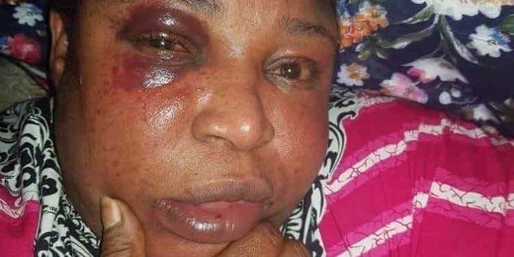 Female Council Chairman Loses Teeth, Bags Swollen Eyes After Brawl With A Fellow Woman In Delta (Photo)