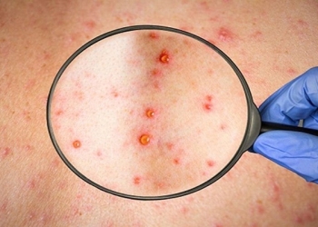 Nigeria Records Ten More Cases Of Monkeypox In One Week